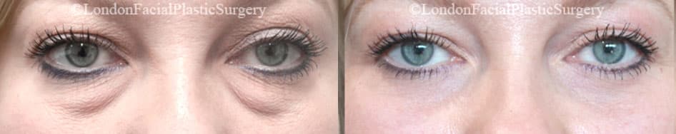 Photo of the patient’s eyes before and after the Blepharoplasty surgery. Patient 6 - Set 1