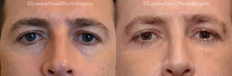 Photo of the patient’s eyes before and after the Blepharoplasty surgery. Patient 3 - Set 1