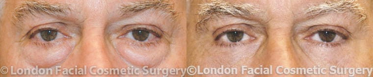 Photo of the patient’s eyes before and after the Blepharoplasty surgery. Patient 2 - Set 1