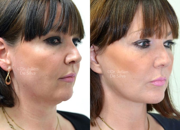 Facelift Before & After Photos - Facelift Surgery London