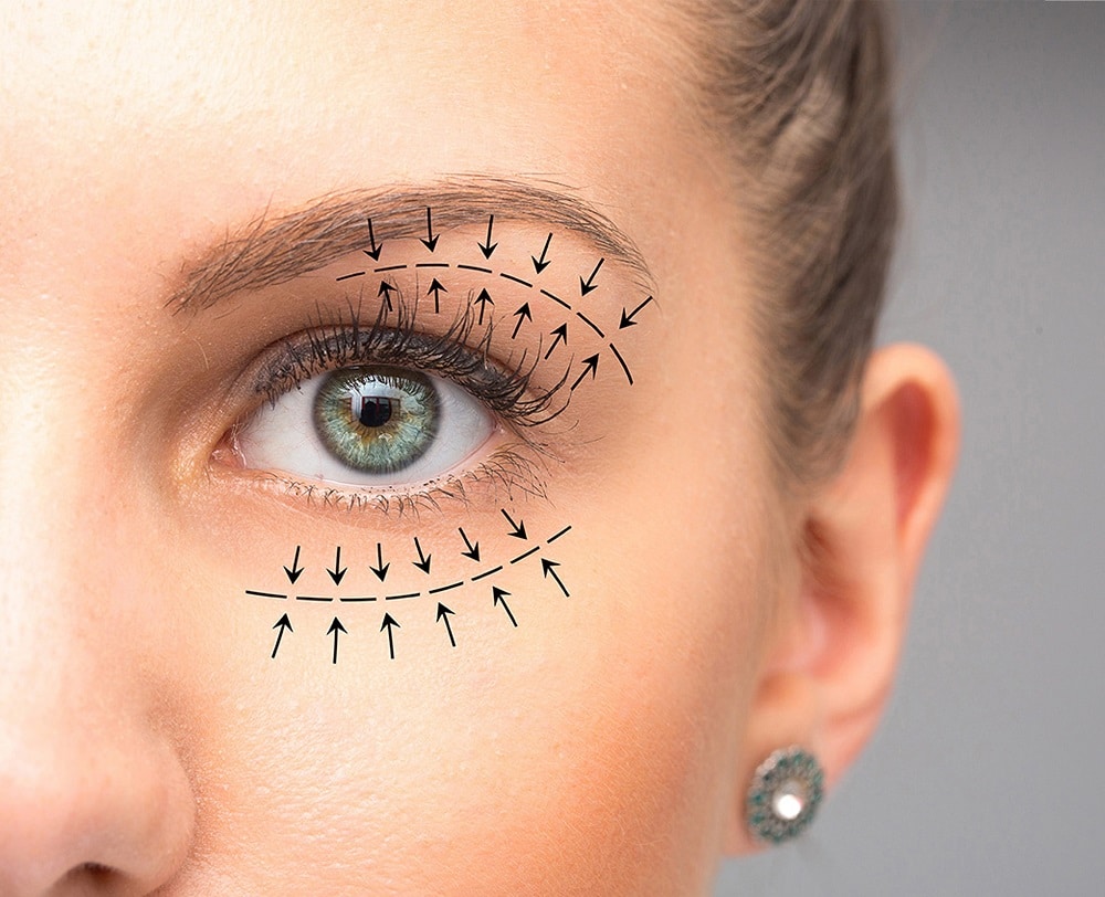 Revision Blepharoplasty in London