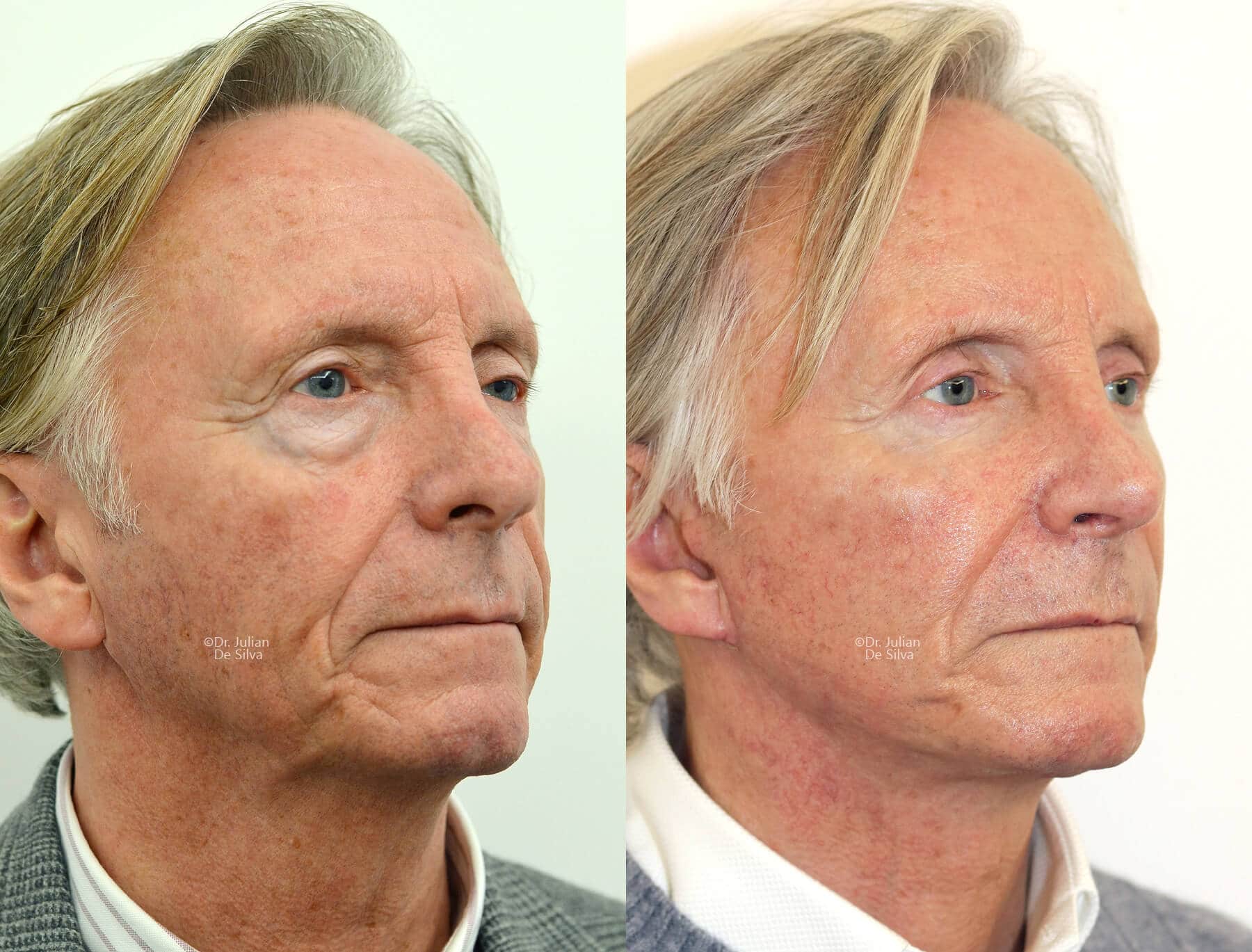 Facelift Before & After Photos - Facelift Surgery London