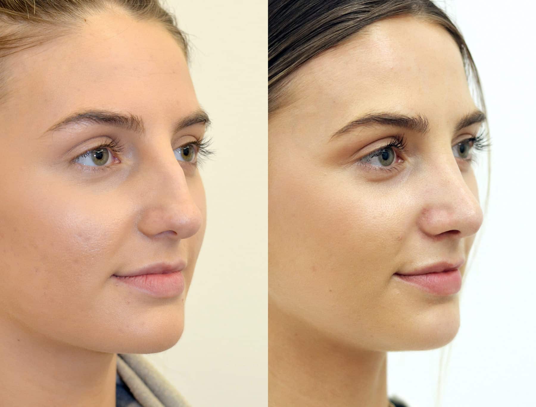 Rhinoplasty: Nose Reshaping in Harley Street, London