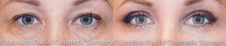 Female eye, before and after Eyelid Surgery treatment, front view, patient 1