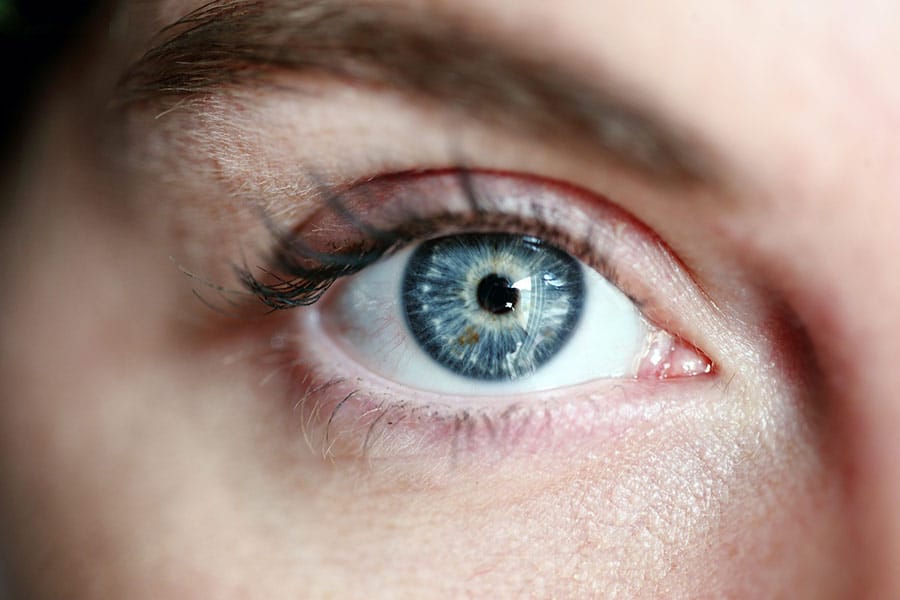 Issues Eye-Lift Surgery Can Solve — patient eye