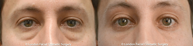  Lower blepharoplasty is considered one of the best treatments for dark circles under the eyes.