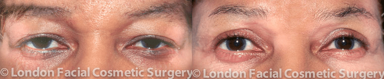 Her friend referred this 63-year-old woman to me because she was concerned that her drooping brows and puffy lower lids were overshadowing her brown eyes.