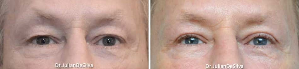 Male eyes, Before and After Eye Lift treatment, front view, patient 4