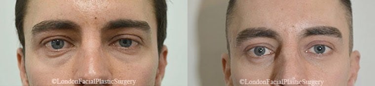 Male eyes, Before and After Eye Lift treatment, front view, patient 6