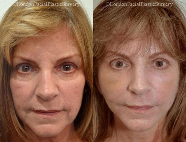 Female face, before and after Mini Facelift treatment, front view, patient 3