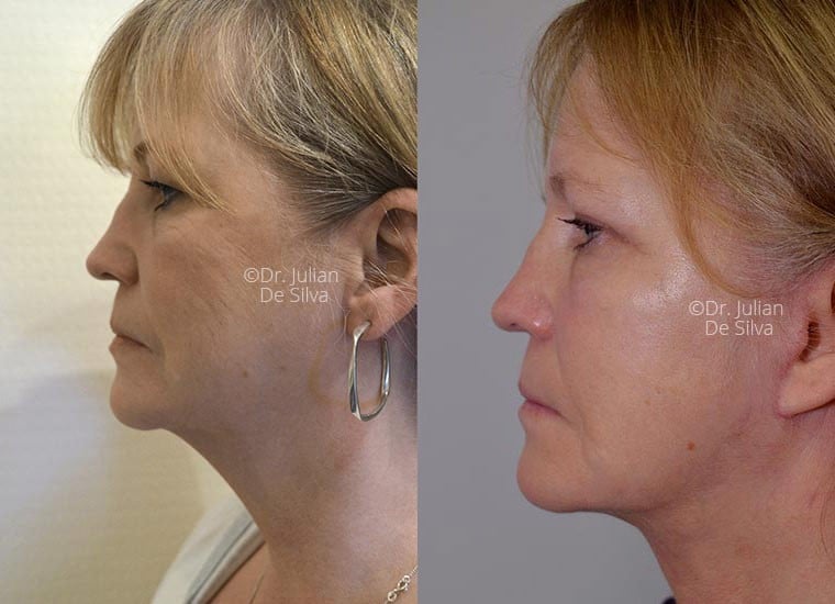 Female face, before and after Mini-Facelift treatment, l-side view, patient 3