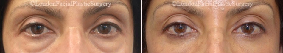 Female eyes, Before and After Eye Lift treatment, front view, patient 7