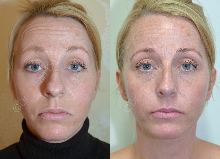 Female face, before and after Rhinoplasty treatment, front view, patient 3