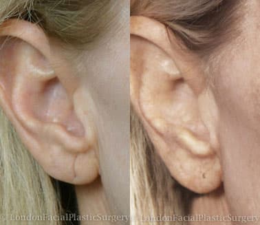 Otoplasty & Ear Pinning Before & After Results in London