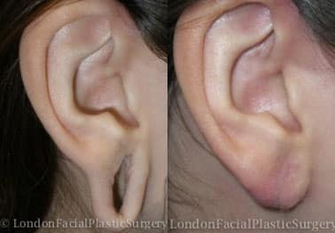 Otoplasty & Ear Pinning Before & After Results in London