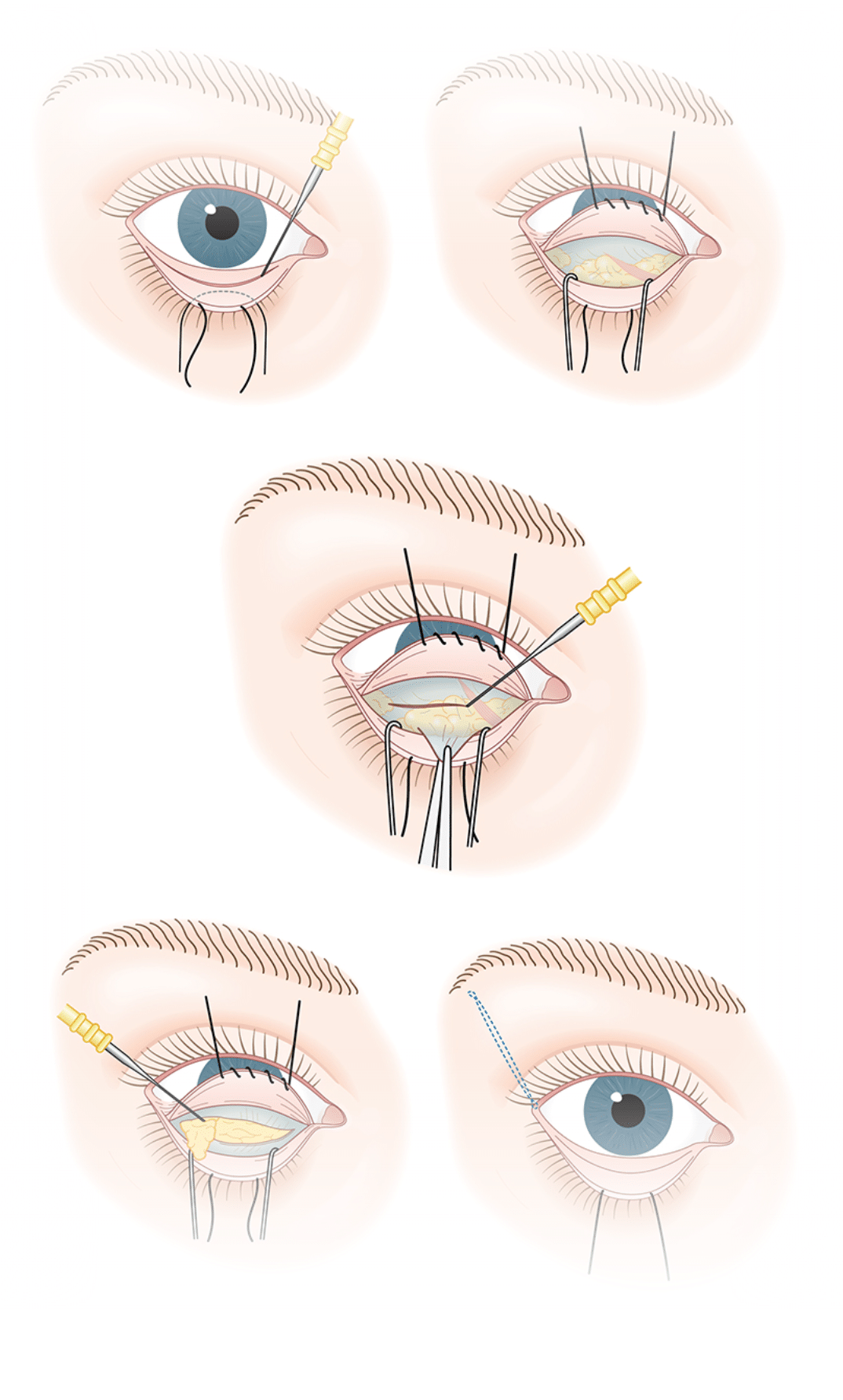 Lower Blepharoplasty Diagram