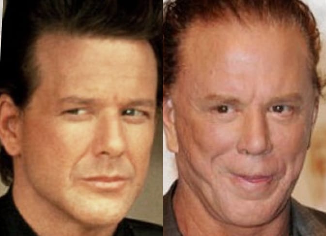 Mickey_Rourke_Eyelids