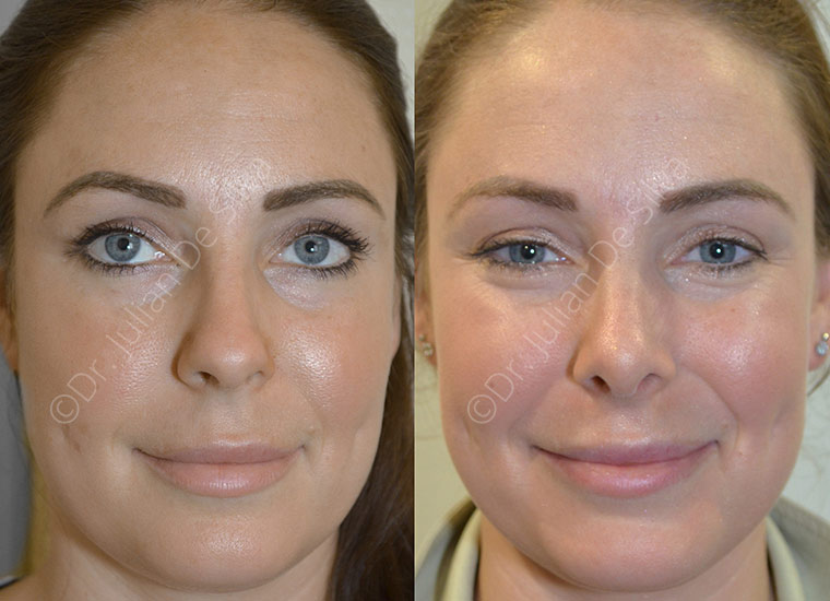 Before and After Photos: Female Nose-Re-Shaping (3)