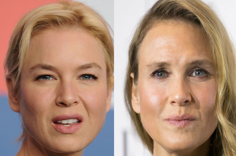 Renee_Zellweger_Eyelid_Surgery