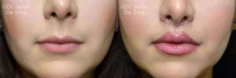 Lip Augmentation & Reduction Before & After Results in London