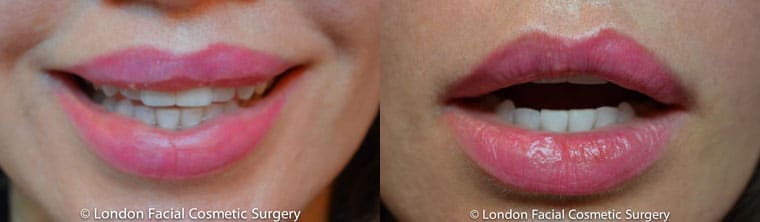 Lip Augmentation & Reduction Before & After Results in London