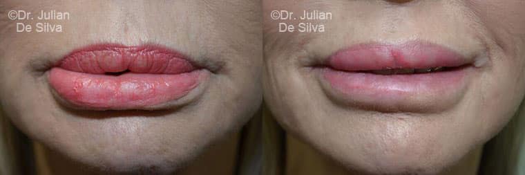 Lip Augmentation & Reduction Before & After Results in London