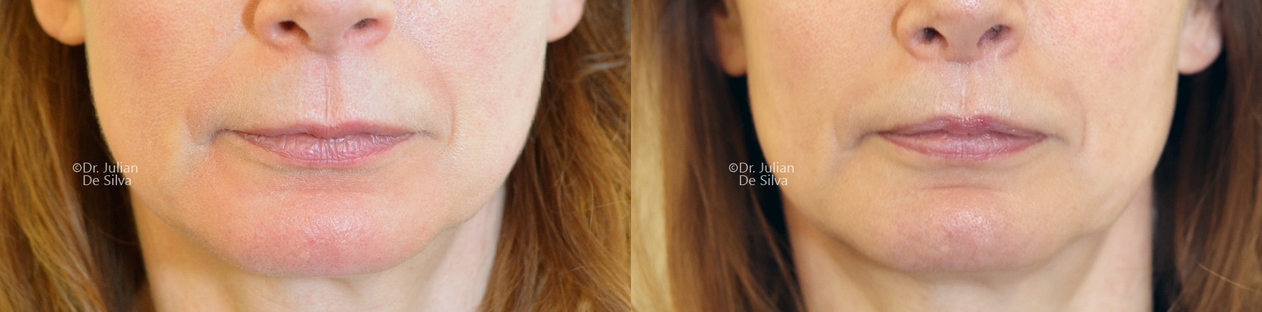 Lip Augmentation & Reduction Before & After Results in London