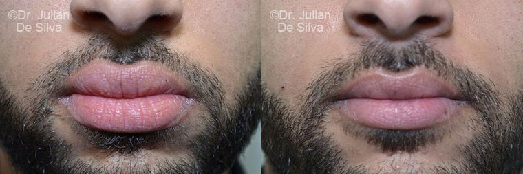 Lip Augmentation & Reduction Before & After Results in London