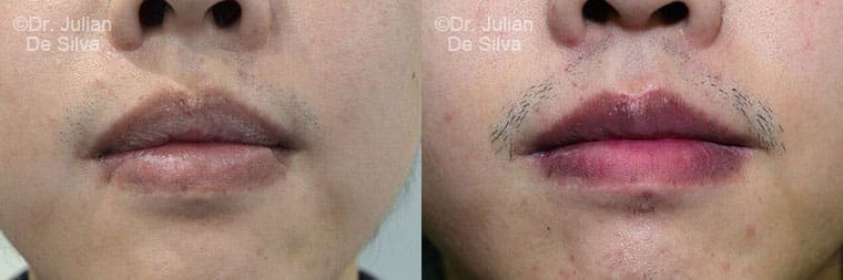 Lip Augmentation & Reduction Before & After Results in London