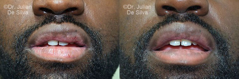 Lip Augmentation & Reduction Before & After Results in London