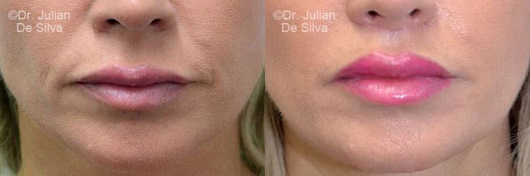 Lip Augmentation & Reduction Before & After Results in London