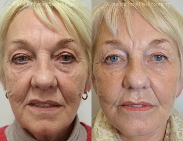 Female face, before and after Mini Facelift treatment, front view, patient 7