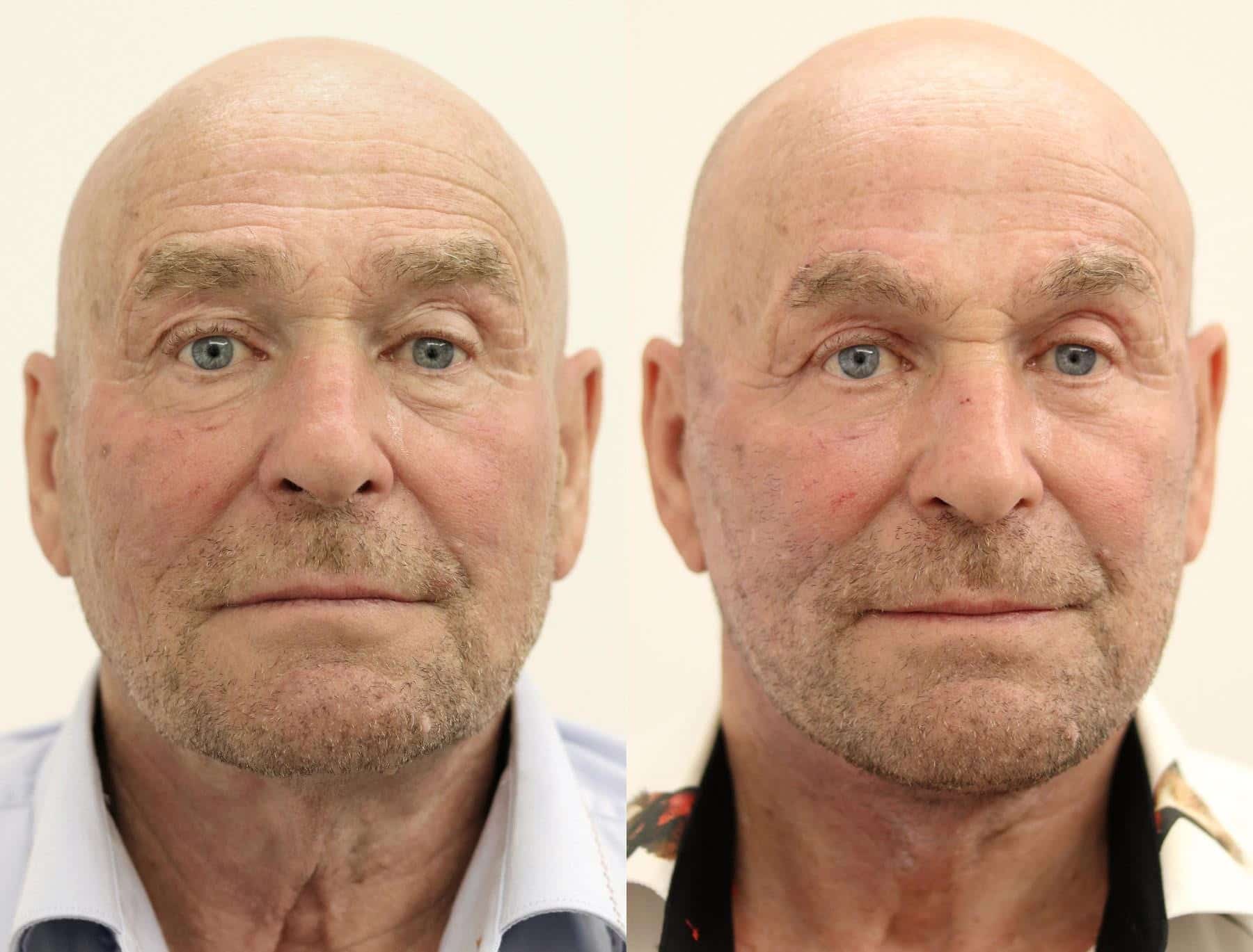 Male face, before and after Mini Facelift treatment, front view, patient 12