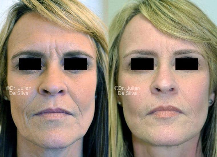 Female face, before and after Mini Facelift treatment, front view, patient 15