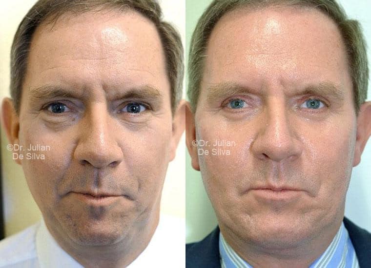 Male face, before and after Mini Facelift treatment, front view, patient 16