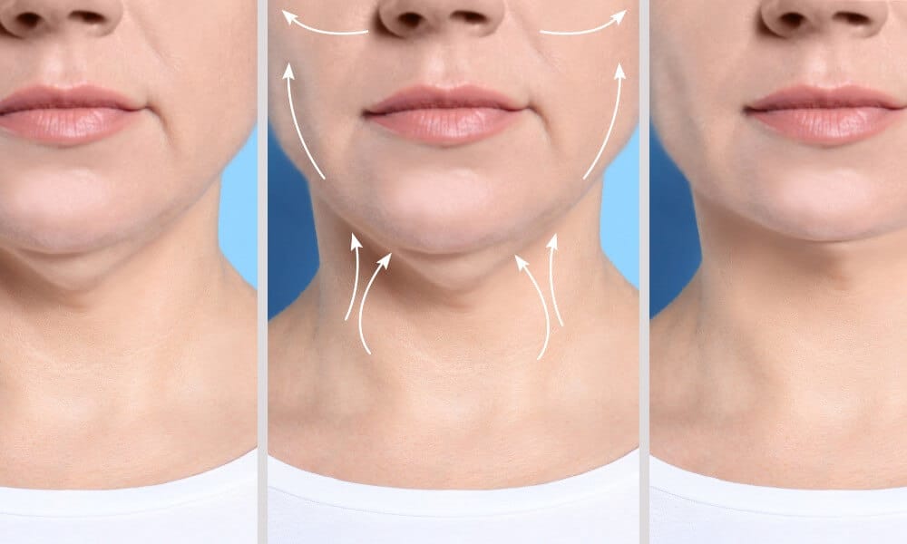 You can have your double chin removed via double chin surgery.