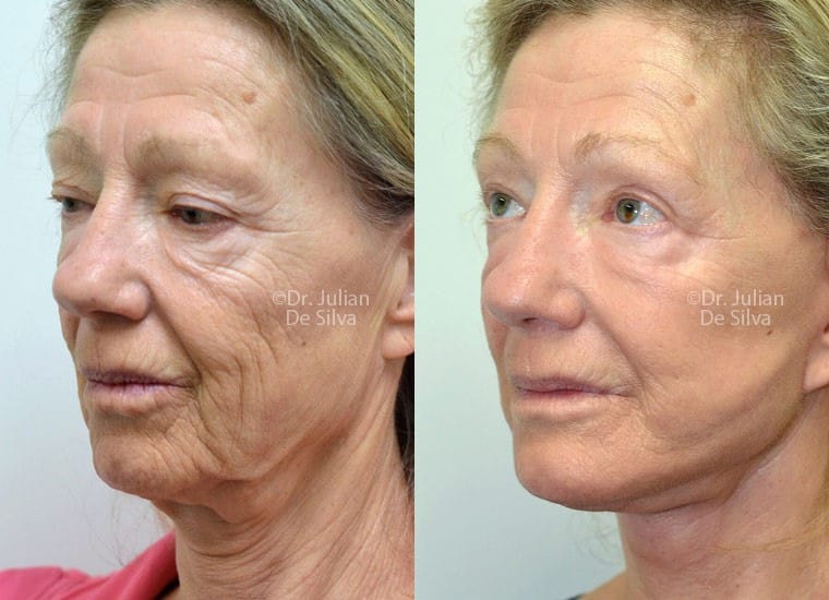 types of facelift procedures