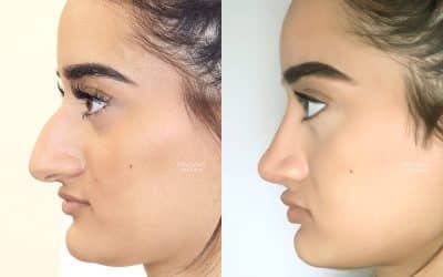 A Patient’s Guide to Rhinoplasty Surgery at LFPS