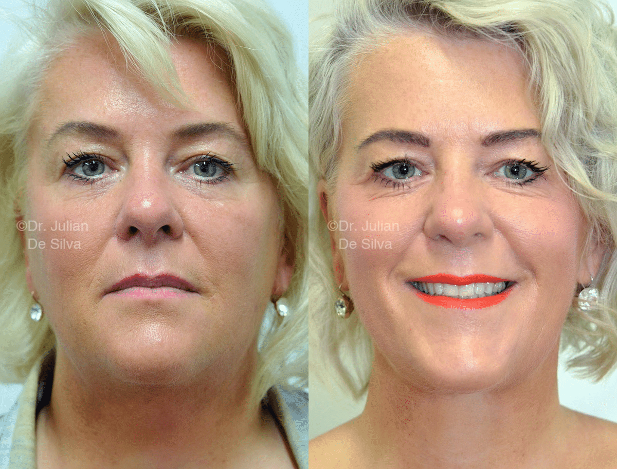 A thread lift is a less invasive cosmetic procedure that can help address sagging skin and excessive fat cells.