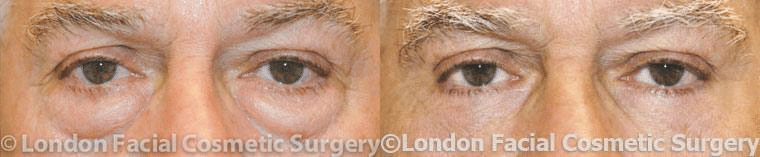 Before and After Blepharoplasty