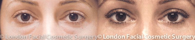 Before and After Blepharoplasty