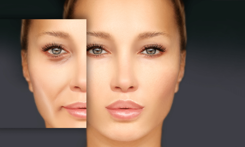 You can follow guidelines to make blepharoplasty recovery faster and easier. Do you want to look more alive? Does sagging skin on your eyes seem to block your vision? Lower blepharoplasty can help. In this article, I will talk about lower blepharoplasty and how you can make recovery time easy and comfortable. I will also answer the most frequently asked questions about the said cosmetic surgery.