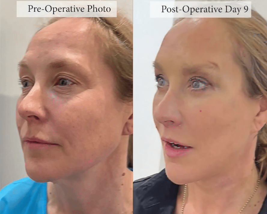 A before and after photo of a patient who had a series of procedures, including a brow lift, with Dr. Julian De Silva. 