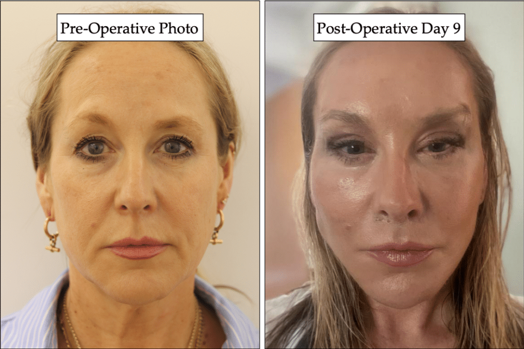 Photo of the patient’s face before and after the Deep Plane Facelift surgery. Patient 1 - Set 1