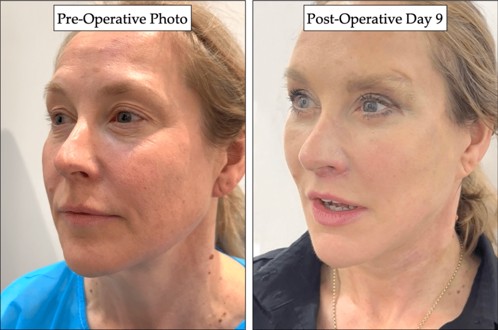 Photo of the patient’s face before and after the Deep Plane Facelift surgery. Patient 1 - Set 2