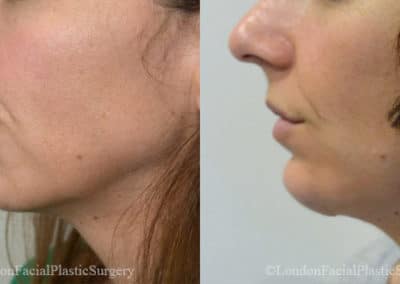 Chin Implants in London Before & After Results