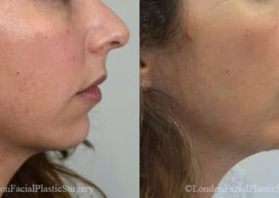 Chin Implants in London Before & After Results