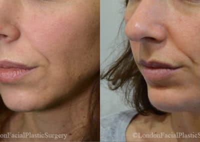 Chin Implants in London Before & After Results