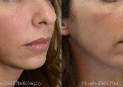 Chin Implants in London Before & After Results