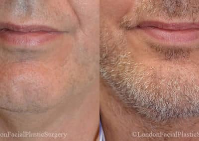 Chin Implants in London Before & After Results